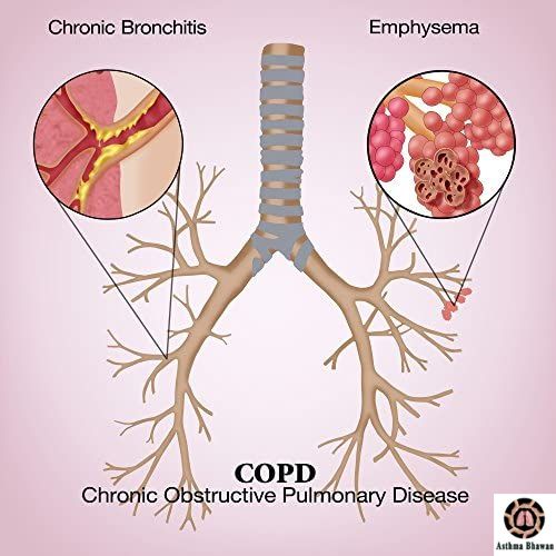 Best COPD Specialist in Vidhyadhar Nagar, Jaipur – Asthma Bhawan