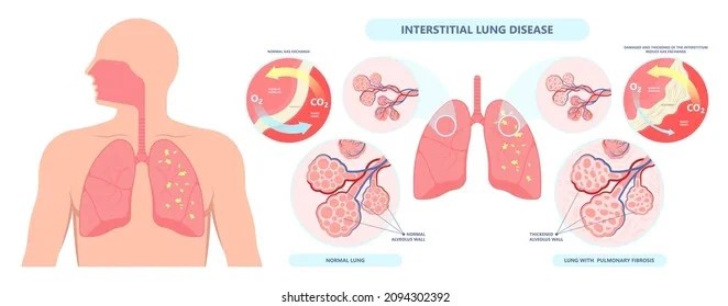 Best ILD Specialist in Jaipur, Rajasthan – Dr. Virendra Singh